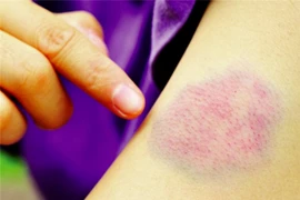 Dấu hiệu nhận biết ung thư máu