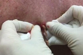 Coi chừng mất mạng vì thói quen nặn mụn 