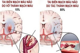 Tai biến mạch máu não: Cấp cứu thế nào để tránh tử vong?