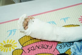 Báo động đỏ nối bàn tay đứt lìa cho bé trai 5 tuổi bị tai nạn giao thông