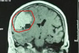 Đi khám đau đầu, phát hiện khối u màng não to hơn quả trứng