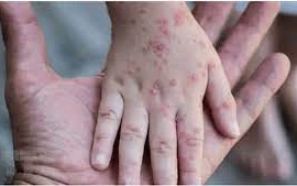 Đồng Nai, Bình Dương có ca đậu mùa khỉ, Bộ Y tế khuyến cáo gì?