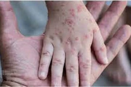Có các triệu chứng này nên nghĩ đến bệnh đậu mùa khỉ