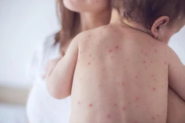 TP.HCM ghi nhận 2 ca bệnh sởi biến chứng viêm phổi