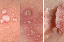 Bị sùi mào gà có vô sinh không?