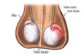 Viêm mào tinh hoàn