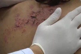 Bị zona thần kinh, ba tôi đòi đưa đến thầy lang vẽ 'bùa khoán'