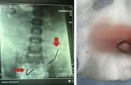 Bé trai 5 tuổi thủng ruột 8 lỗ vì nuốt 20 viên nam châm