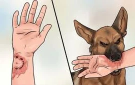Xử trí đúng cách ngay sau phơi nhiễm để phòng ngừa bệnh dại