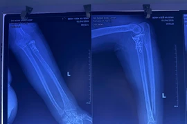 Phối hợp chuyên khoa sâu cứu bệnh nhân gãy xương khỏi 'tam chứng đau khổ'
