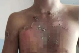 Năm nam sinh được cho là bị bóp cổ liên tục cho đến khi họ bất tỉnh sau đó lại bị dội nước sôi vào người.