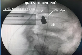 Lấy thành công đầu đạn 51 năm nằm trong cơ thể