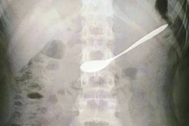 Cứu cô gái 20 tuổi đi uống cà phê nuốt chiếc thìa vào bụng 