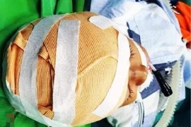 Nghệ An: Bé 5 tuổi bị chó đẻ cắn rách da đầu, lộ xương sọ