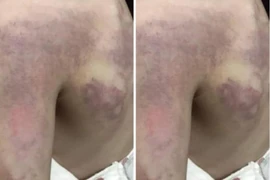 Tạm đình chỉ công tác cô giáo đánh học sinh bầm vai