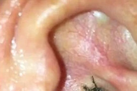 Sốc khi phát hiện trong tai có... nhện