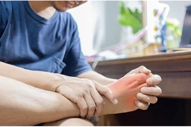 5 cách tự nhiên để kiểm soát nồng độ axit uric trong cơ thể