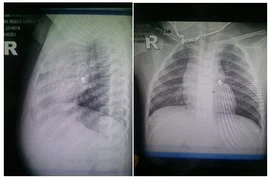Gắp thành công dị vật kim loại trong khí quản bé 20 tháng tuổi