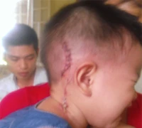 Trưng cầu giám định bé 14 tháng tuổi bị con nợ của bố chém vào đầu