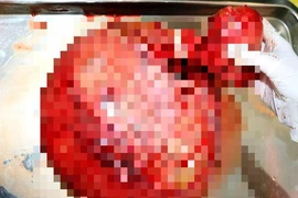 Tự uống thuốc, để khối u xơ nặng tới 4kg