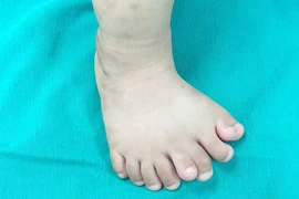 Hy hữu: Bé trai Thanh Hóa có 9 ngón trên 1 bàn chân 