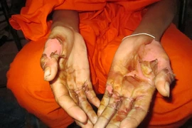 Bị bắt nhúng tay vào nước sôi để chứng minh 'không ăn cắp'