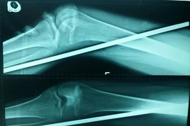 Cây sắt đâm từ đùi xuống mắt cá chân trái cô gái 