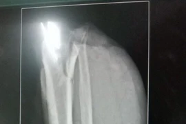 Ngồi trong ô tô cũng bị đứt lìa đùi trái