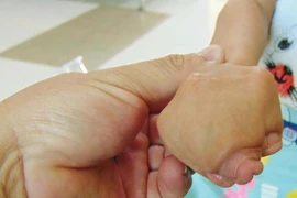 Mổ tách bàn tay 'dính chùm' cho bé gái 8 tuổi