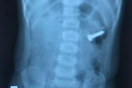 Bé gái 2 tuổi nuốt chiếc đinh ốc xoắn dài 3 cm