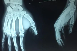 Nối thành công đốt ngón tay cái bị xích xe cắt đứt 
