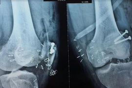 Người đàn ông bị chân vịt ca nô chém lộ xương chân