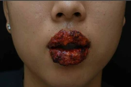Suýt mất cặp môi sau khi xăm