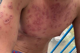 Tưởng dị ứng thuốc, té ra mắc hội chứng hiếm gặp ở nam giới