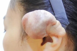 Suýt mất tai do xỏ 6 khuyên để thể hiện cá tính