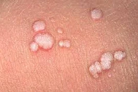 Dễ lây lan như mụn cóc
