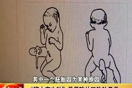 Bé trai 2 tuổi "mang thai" người anh em sinh đôi