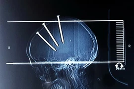 Ba cây đinh cắm vào sọ vẫn sống sót