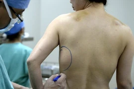 Hoảng hốt vì bộ ngực cấy ghép “chạy” xuống bụng