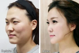 Nhập cảnh không được vì quá đẹp sau giải phẫu thẩm mỹ