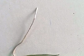 Nội soi lấy cọng kim loại trong phế quản bệnh nhân