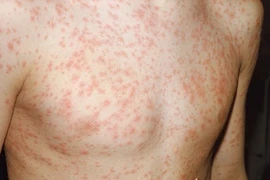 Các bệnh sốt phát ban: dễ nhầm lẫn!