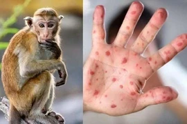 Tiền Giang phát hiện ca đậu mùa khỉ đầu tiên là một người làm vườn