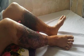 Bị bỏng nặng hai chân khi lội qua mương có chất thải độc hại