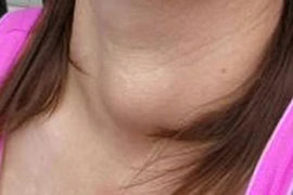 Bướu giáp ở phụ nữ phát triển gấp 5 lần nam giới