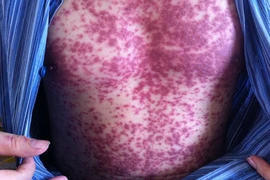 Viêm loét bộ phận sinh dục sau khi dùng thuốc trị gout