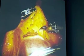 Lần đầu tiên dùng robot phẫu thuật ung thư dạ dày