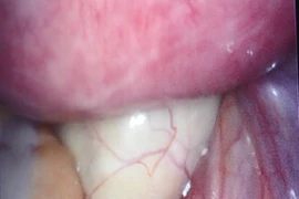 Cứu sản phụ bị u buồng trứng xoắn, kích thước khủng