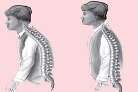 Tại sao dùng canxi đắt tiền vẫn bị loãng xương?