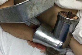 1 phụ nữ nhập viện với máy xay thịt dính vào tay